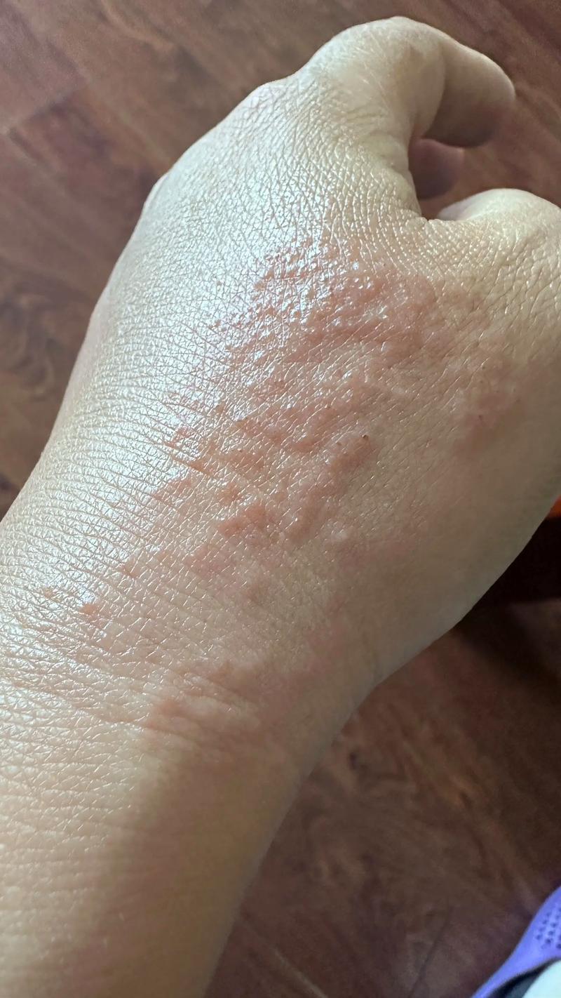 针灸后身上起红疙瘩是