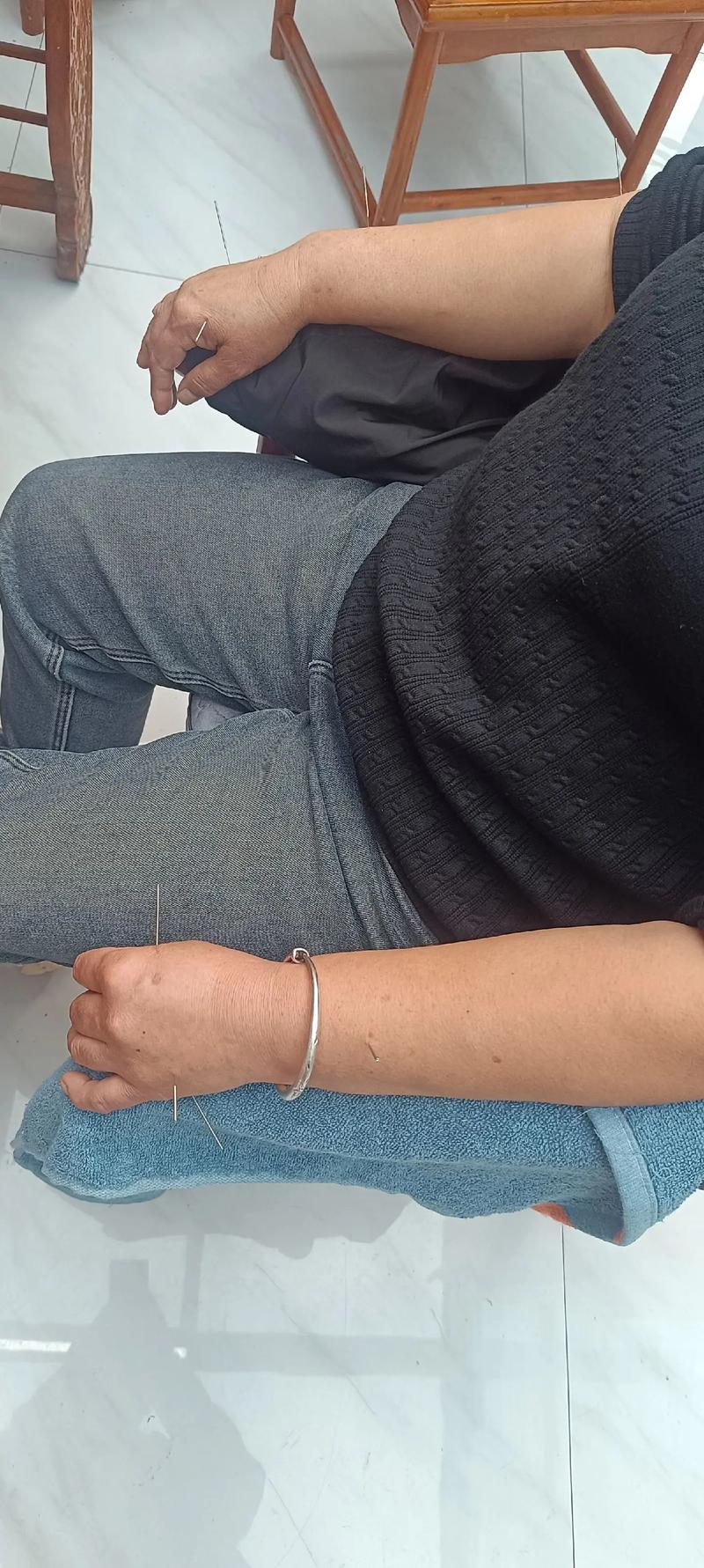 针灸怎样治疗脊髓损伤