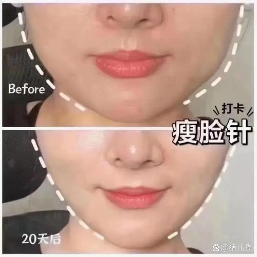 botox瘦脸针安全嘛