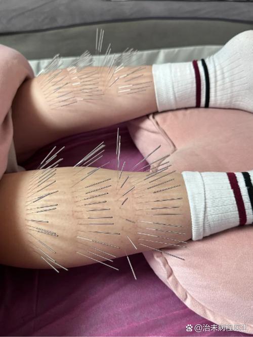 小腿针灸后的最佳反应