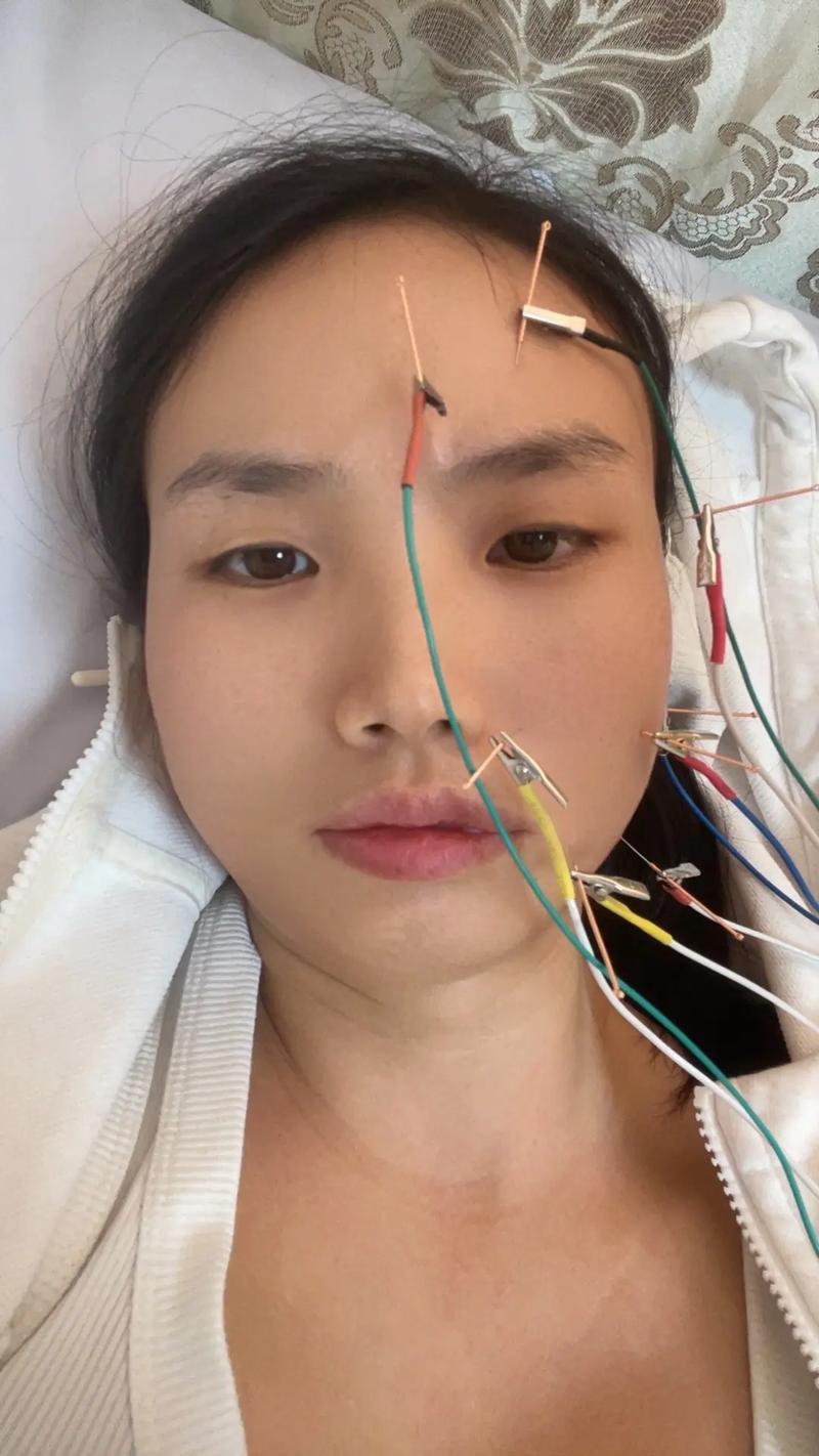 面瘫针灸引起面肌痉挛