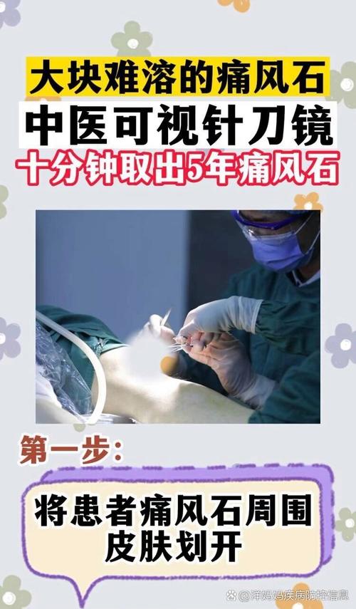 针刀镜治疗痛风安全吗