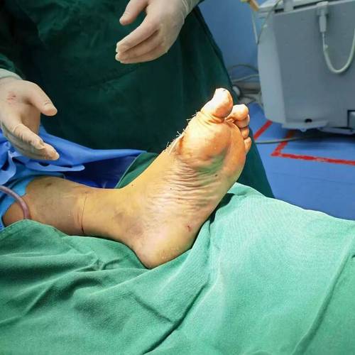 针刀镜治疗痛风安全吗