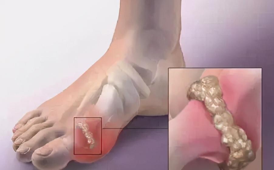 针刀镜治疗痛风安全吗