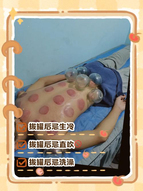 针灸之后可以拔火罐吗