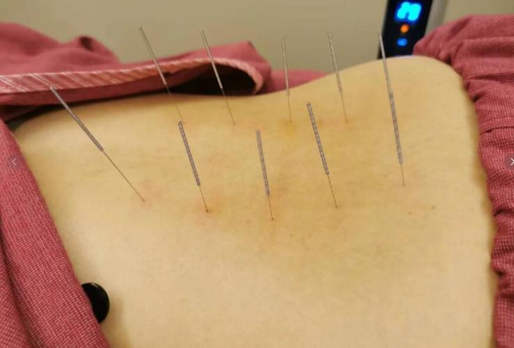 不来月经可以扎针灸吗