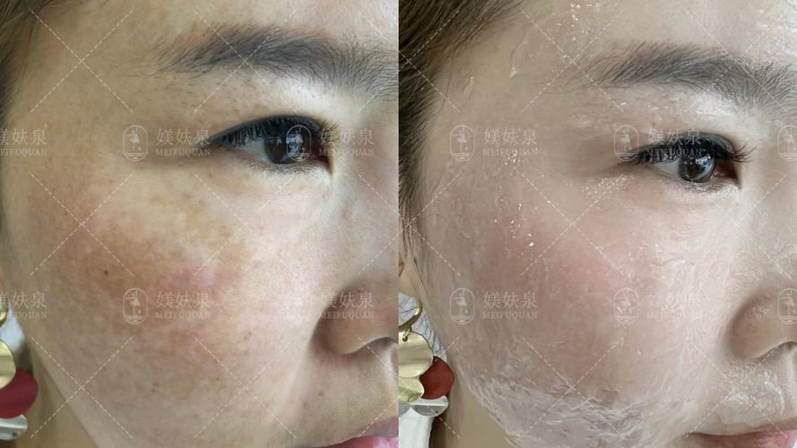 24磁光净肤去斑安全吗