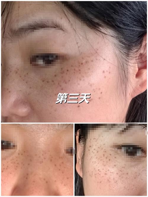 24磁光净肤去斑安全吗