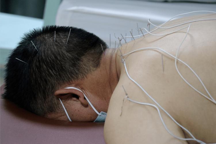 电子针灸仪的效果怎样