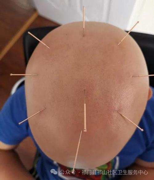 用针灸治疗斑秃的频率