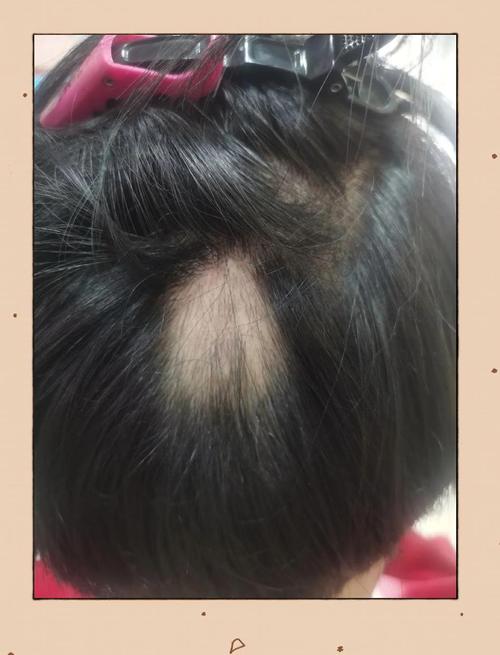 用针灸治疗斑秃的频率