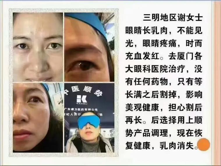 广东康力隐形针灸眼罩