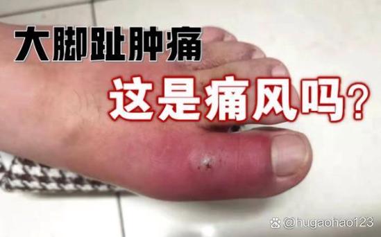 大脚趾痛风可以泡脚吗