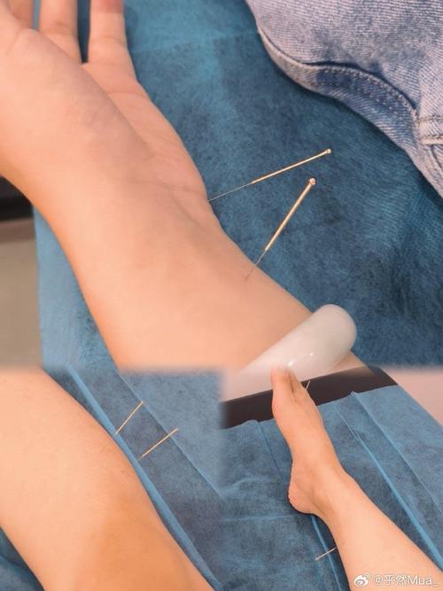 腿部有血栓可以针灸吗