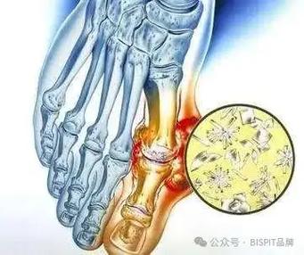 痛风 溶晶为什么会痛