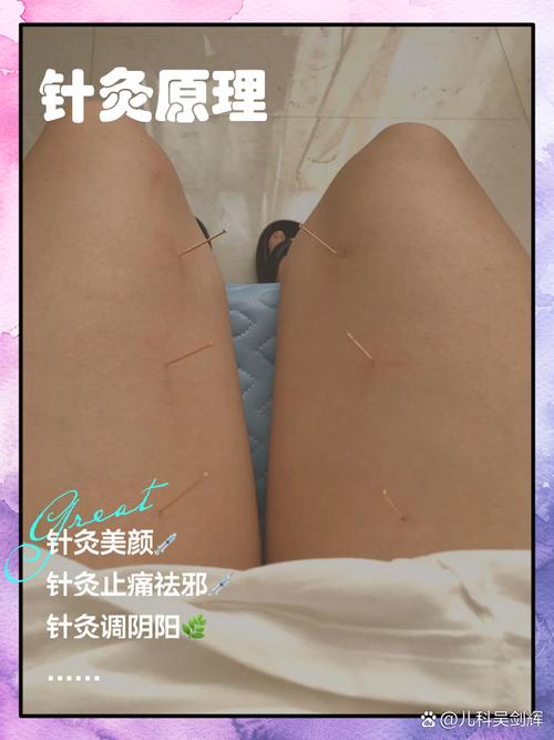 试管移植前内膜薄针灸