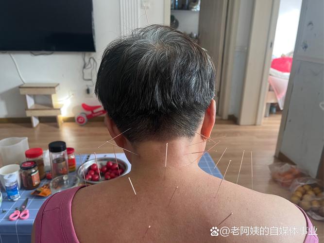 针灸治疗脑梗言语不清