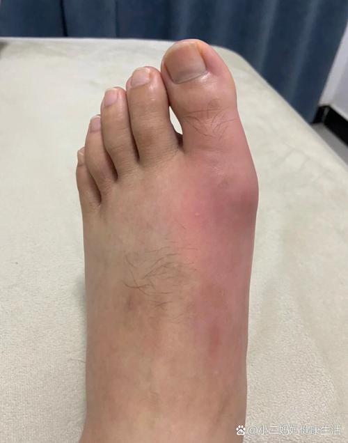 痛风红肿一般几天消肿