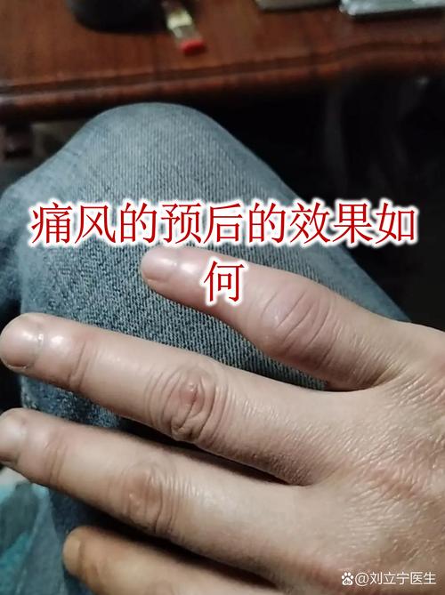 东革阿里对痛风的效果