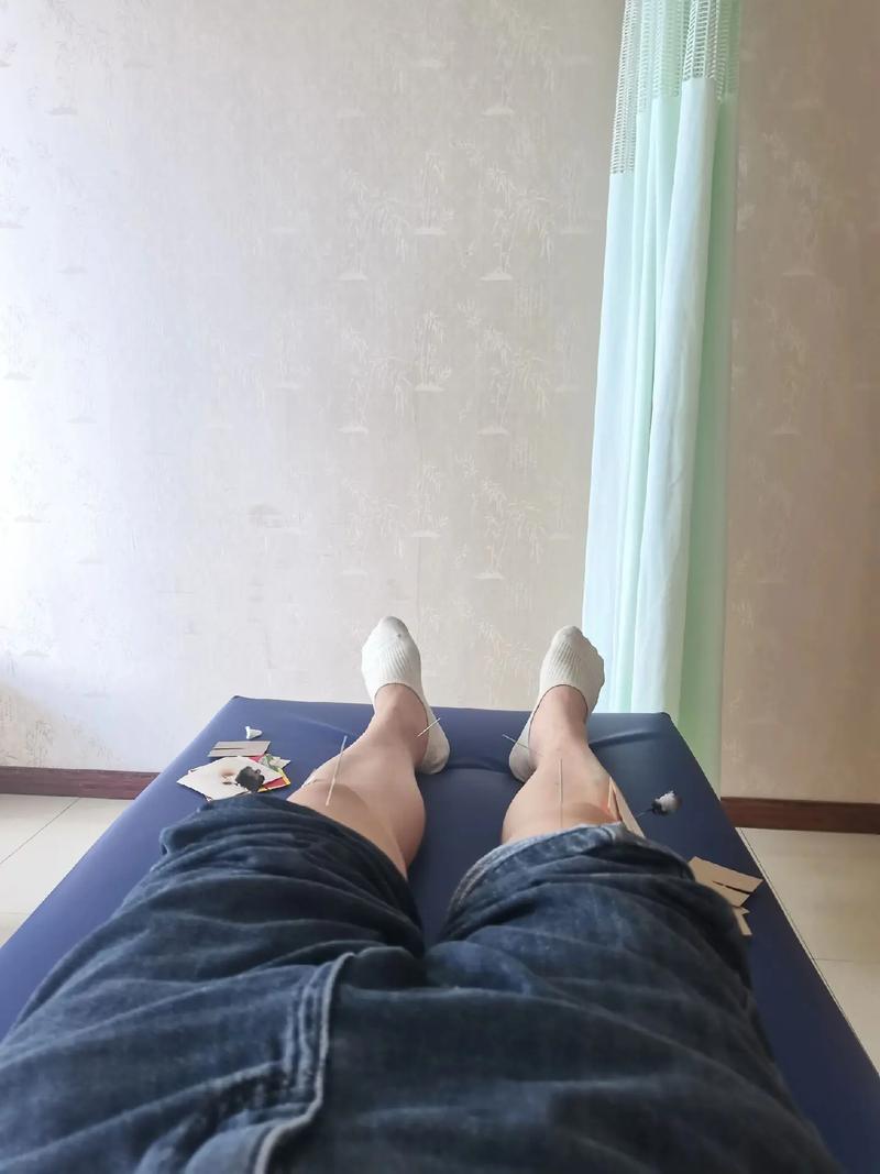 针灸可以治疗寻麻疹吗