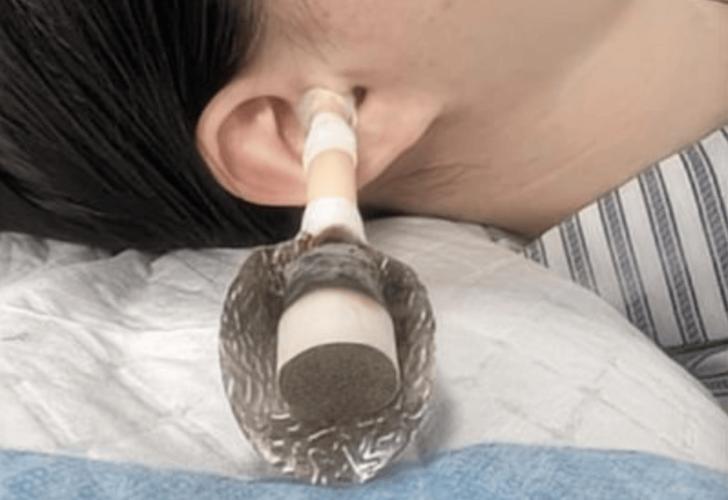 针灸治疗耳鸣效果如何