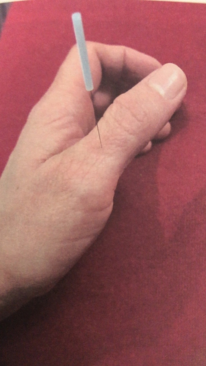 手心出汗针灸怎么治疗