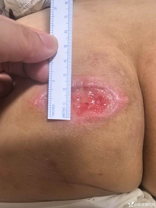 针灸后大便增多屁增多