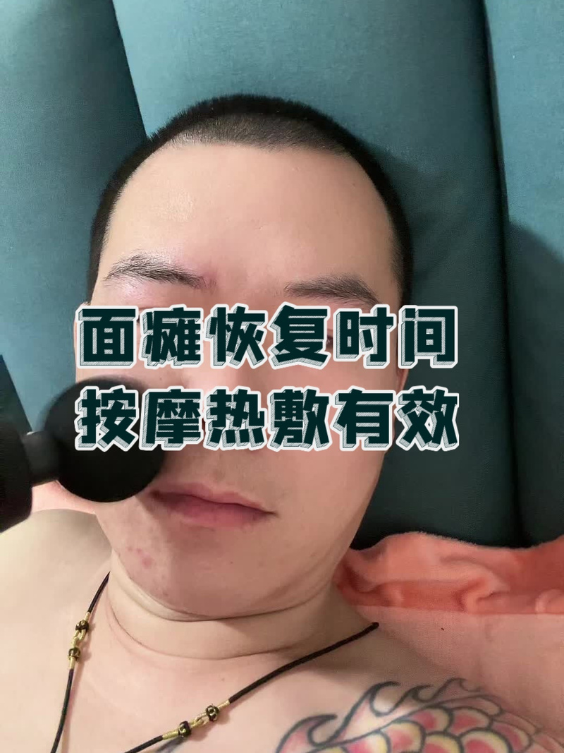 面瘫针灸之后能热敷吗