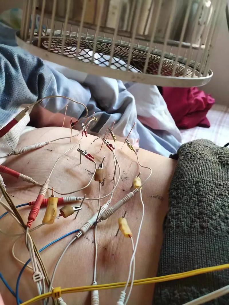 针灸治疗腰腿痛怎么样