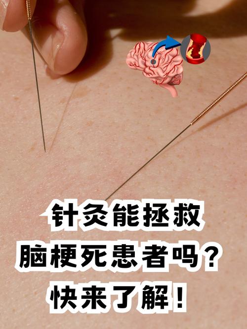 针灸治什么病效果最好