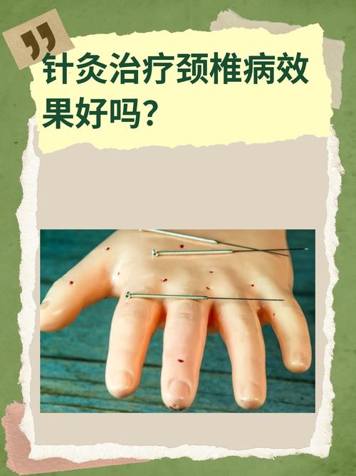 颈椎针灸向内上方斜刺