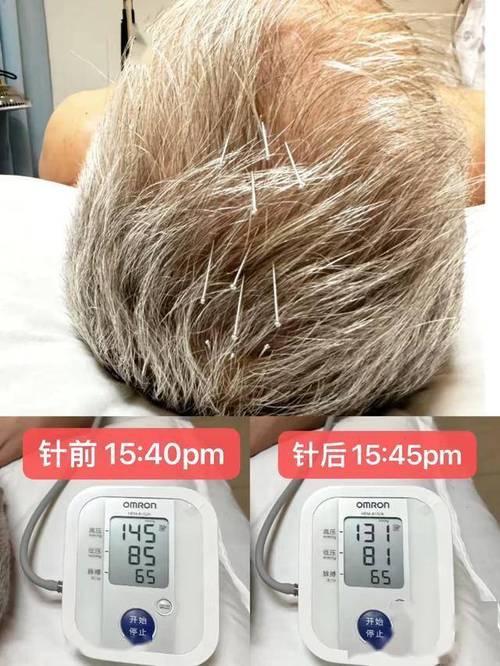 高血压能用针灸治疗吗