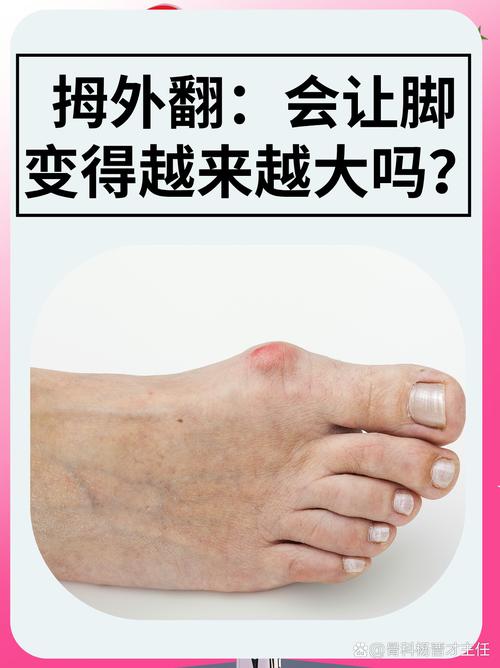 拇外翻容易引发痛风吗