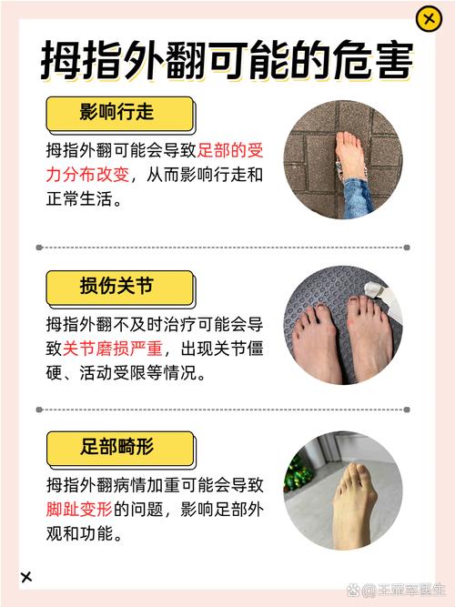 拇外翻容易引发痛风吗