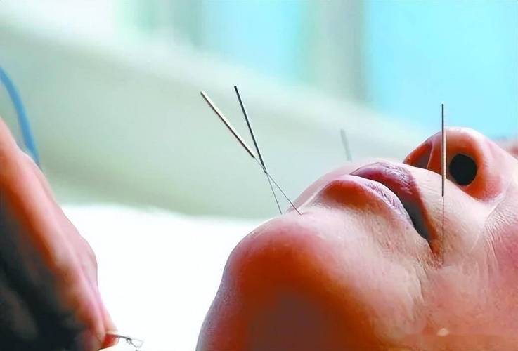 面瘫针灸好了后嘴角跳