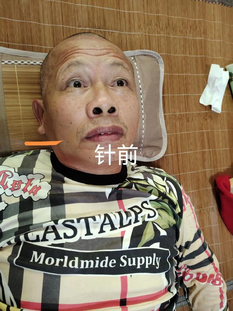 面瘫针灸好了后嘴角跳