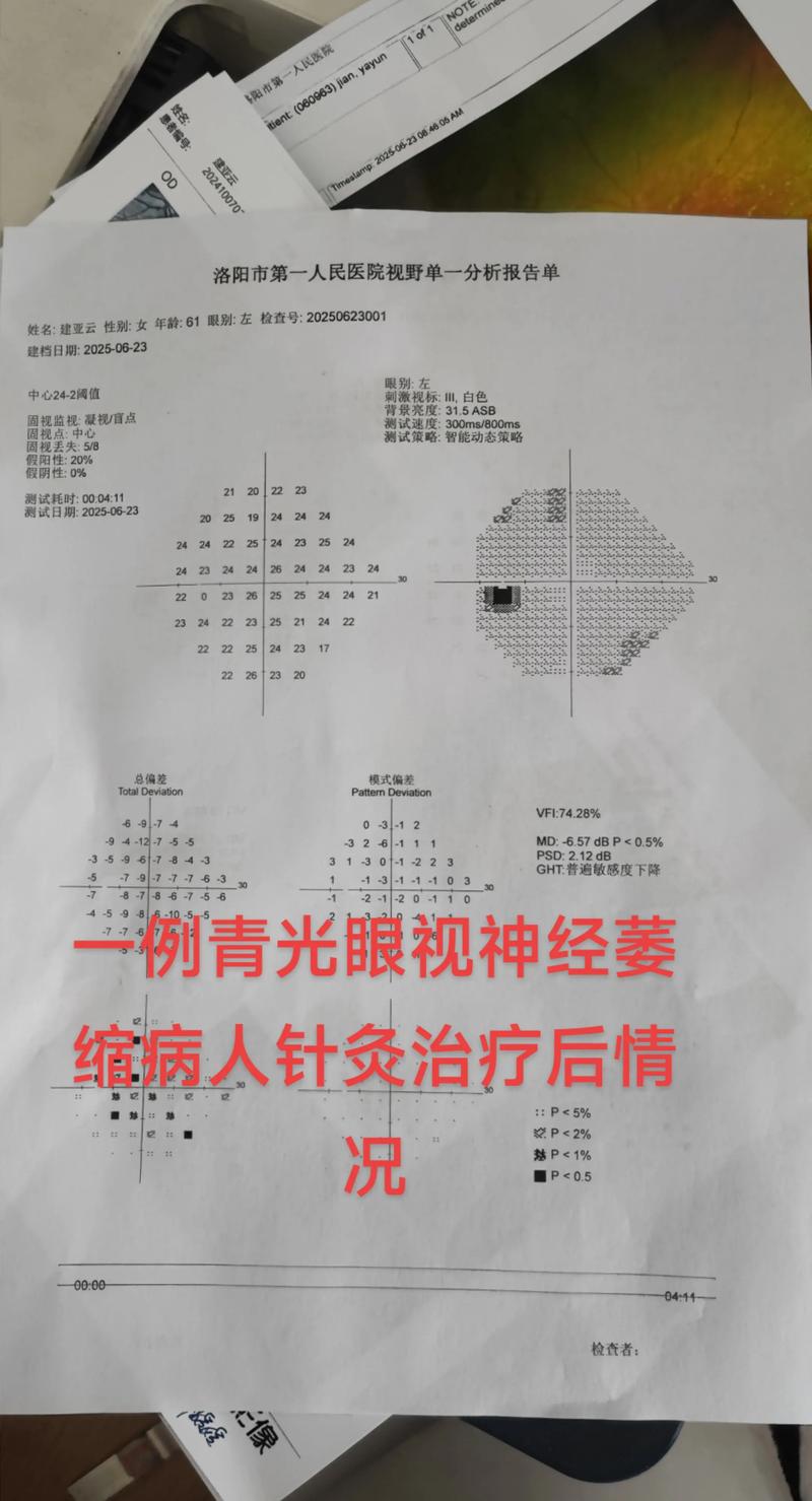 视神经萎缩针灸有效吗