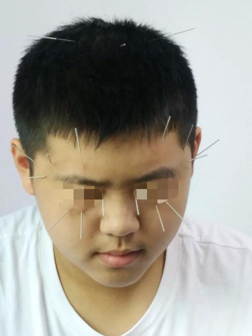 视神经萎缩针灸有效吗