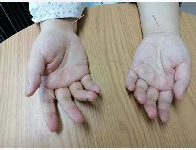 视神经萎缩针灸有效吗