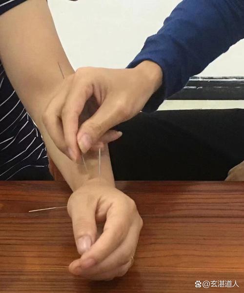 慢性咽炎可以扎针灸吗