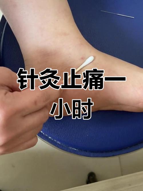 尿酸高痛风可以针灸吗