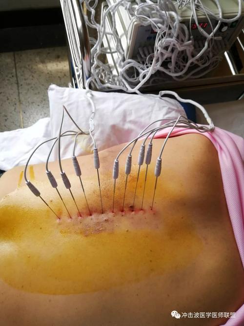 针灸治疗带状疱疹视频