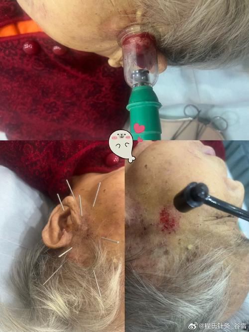 针灸治疗带状疱疹视频