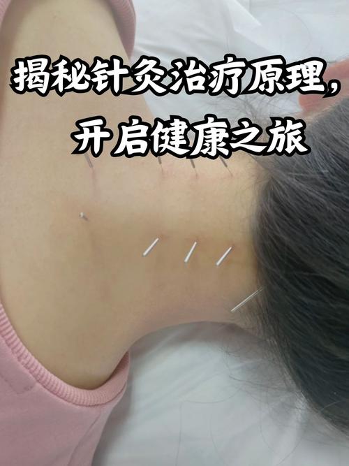 益安门诊针灸减肥图片