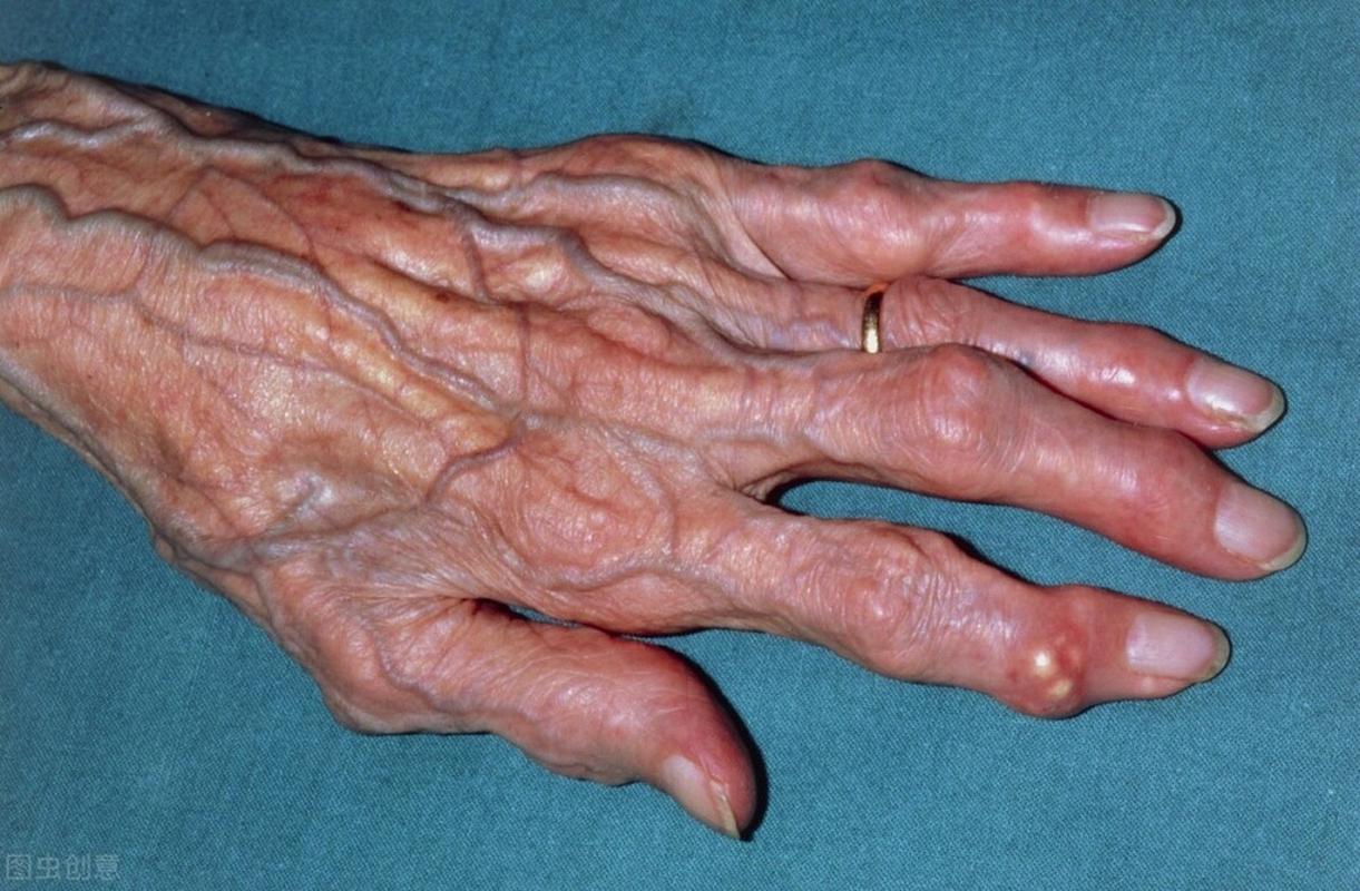 风湿痛风的症状有哪些