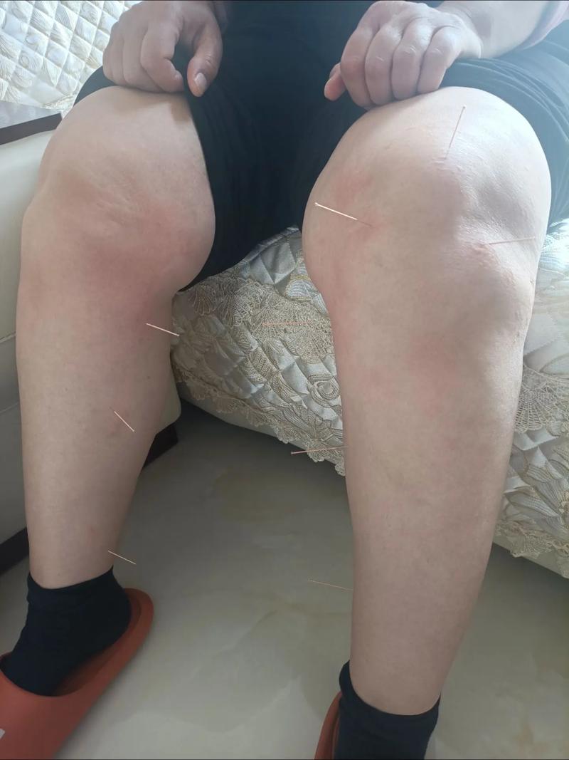 背痛针灸怎么扎膝盖啊