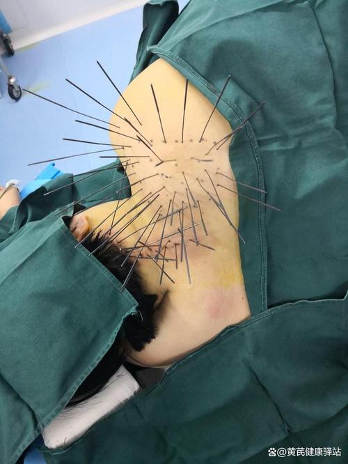 肩周炎针灸效果怎么样