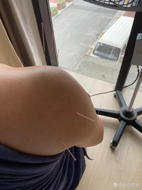肩周炎针灸效果怎么样