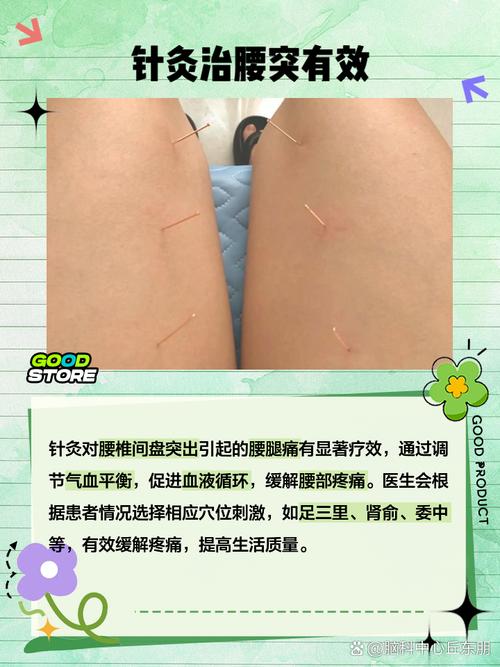 针灸治腰痛多少天有效