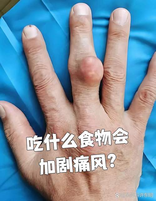 痛风可以偶尔吃卤煮吗